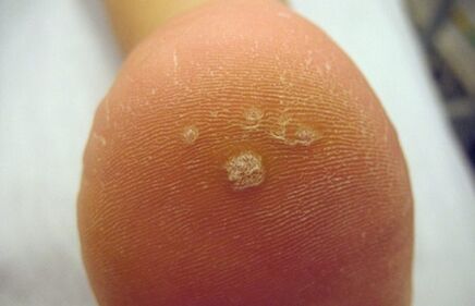 How to recognize a wart of Pierce