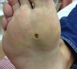 Ways to remove the wart about the leg sole