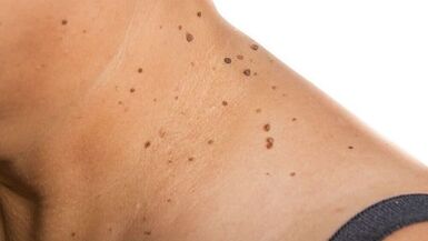 How to get rid of the papilloma in the neck