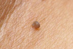 Clinical picture of the papilloma