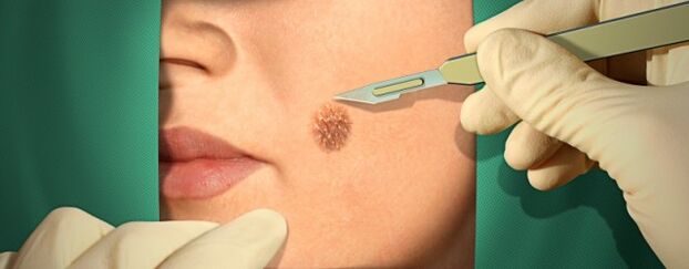 Papilloma surgical treatment