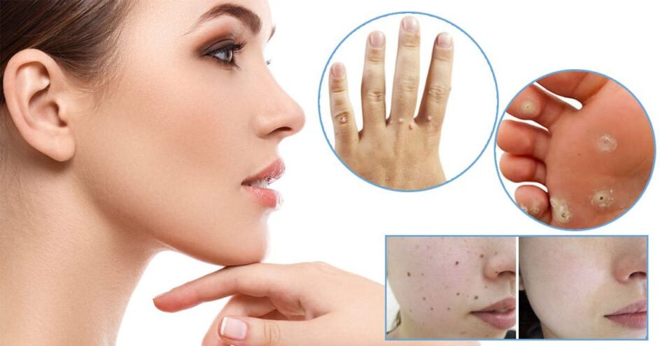 Methods of removing papillomas