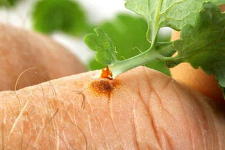 How to remove Papillomi with popular remedies