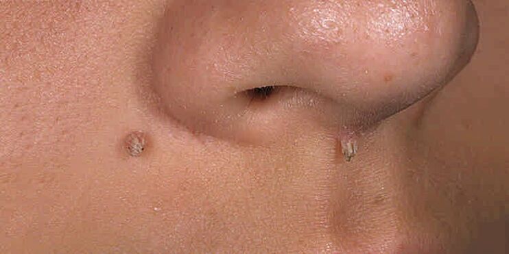 The reasons for the appearance of the papillomas