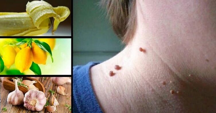 What is Papillomas