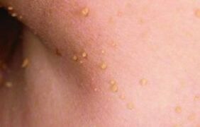 The reasons for the appearance of the papillomas on the body
