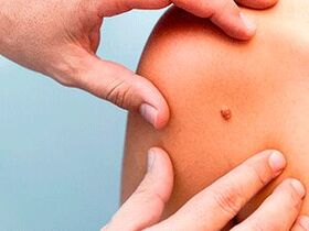 reasons for the appearance of papillomas on the body