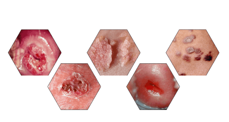 Why papillomas are dangerous