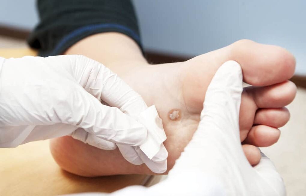 why warts appear on the body