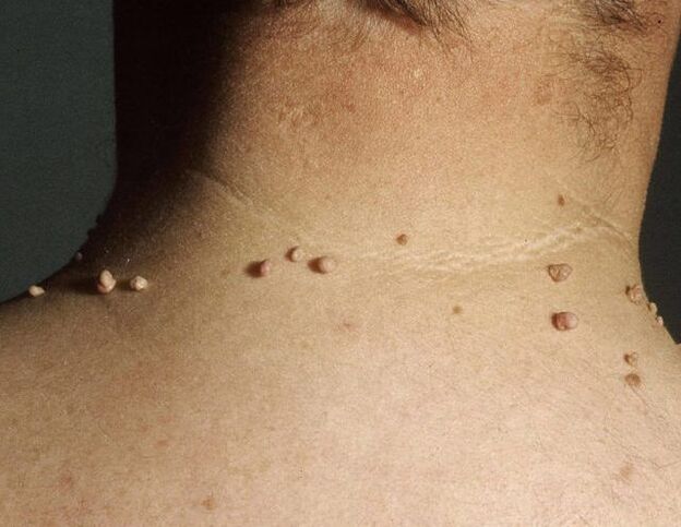Papillomas on the neck of a man
