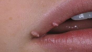 Papillomas on the lips