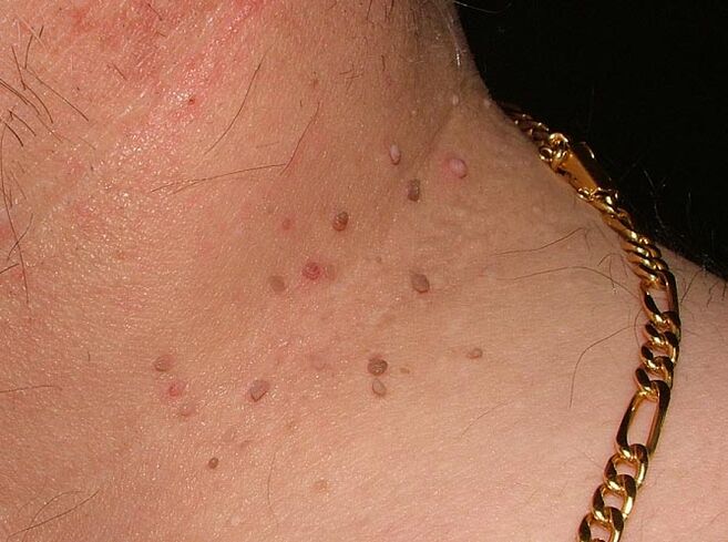 Papillomas on the neck