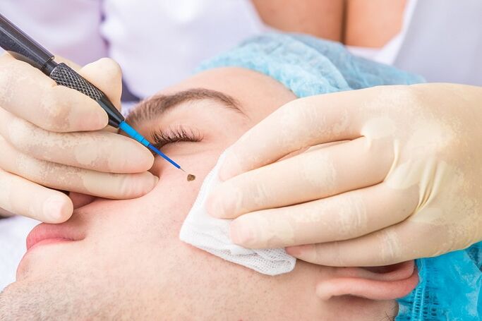 removal of papilloma on the face due to human papillomavirus
