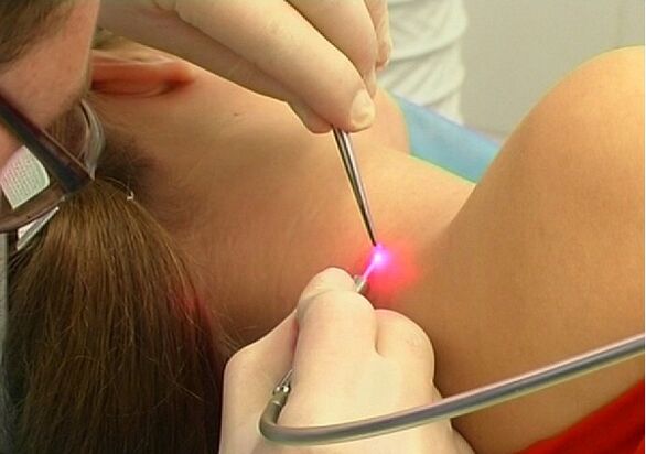 Low trauma method for laser papilloma removal